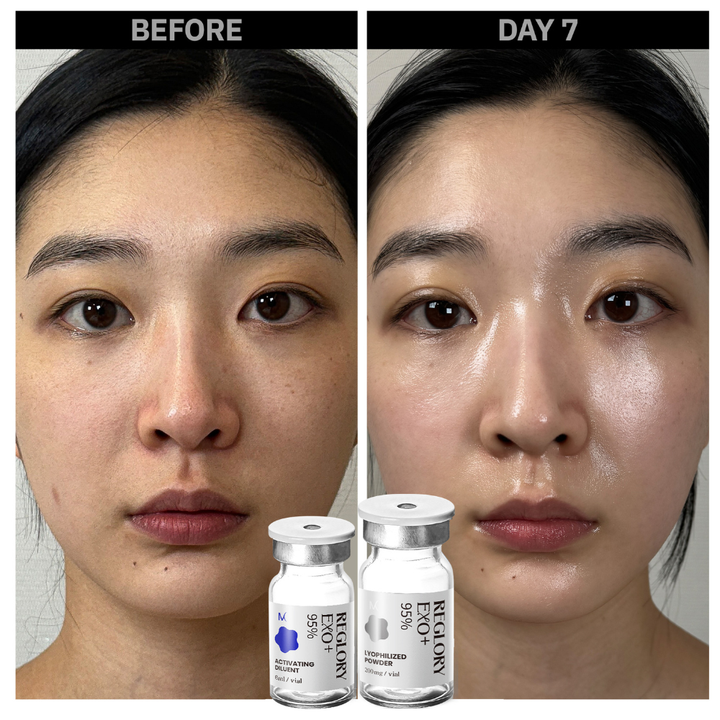 Reglory EXO Exosome Skin Booster before and after. Showing skin looks brighter, more glow, smoother, pores looks smaller