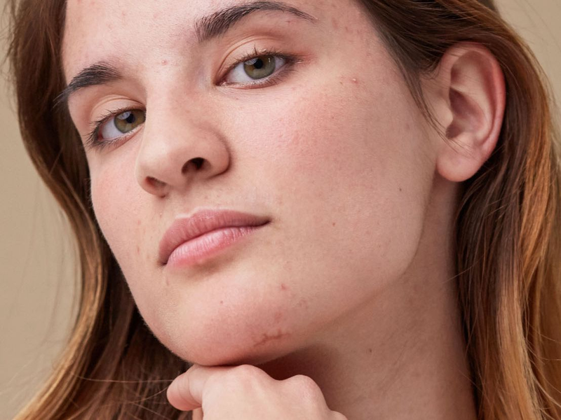 How to get rid of your acne scars for good