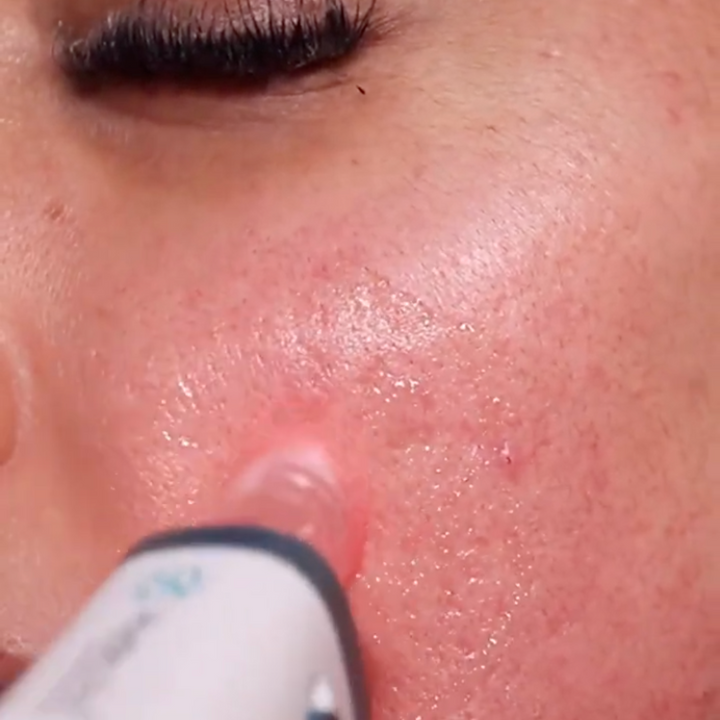 Hydra Pen H6 Advanced Serum Infusion Microneedling Pen with Light Therapy