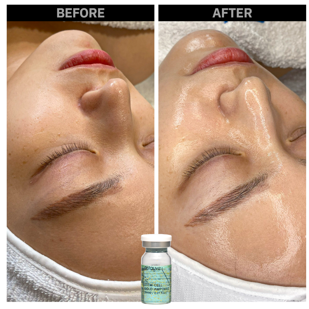 Before and after comparison of a woman's skin area after treatment with AC Stem Cell Gold Ampoule.