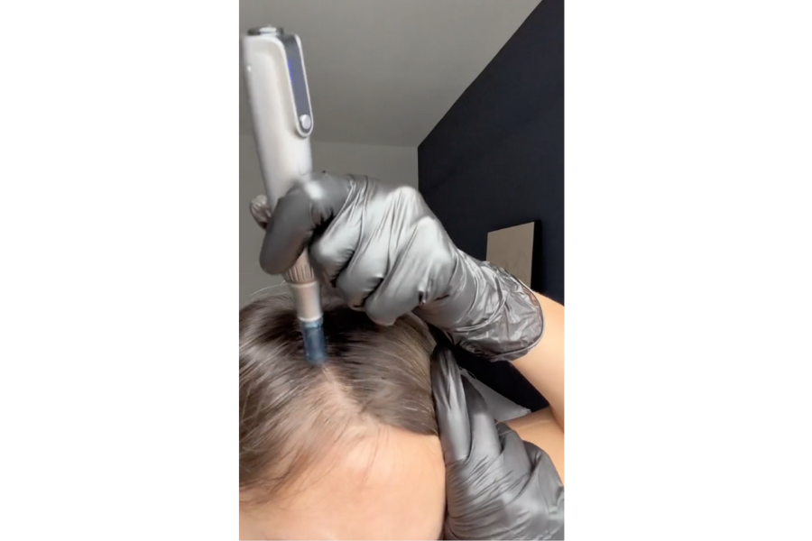 Close up to microneedling on scalp