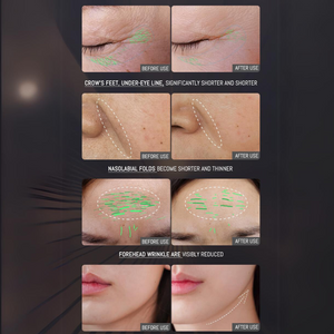 PRO Facial RF Skin Tightening Wand before after
