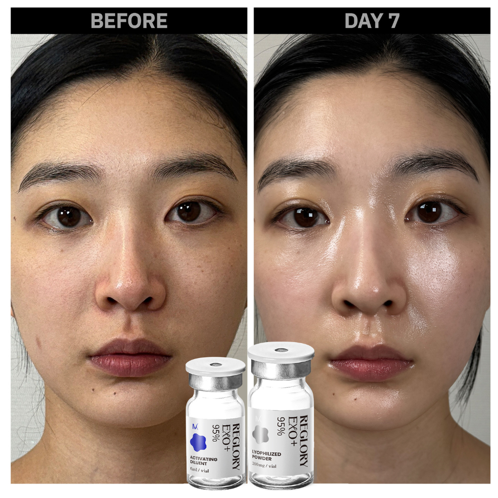 Reglory EXO Exosome Skin Booster before and after. Showing skin looks brighter, more glow, smoother, pores looks smaller 