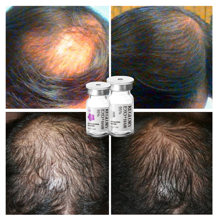 Before after treatment with Reglory EXO⁺ Hair Growth Serum