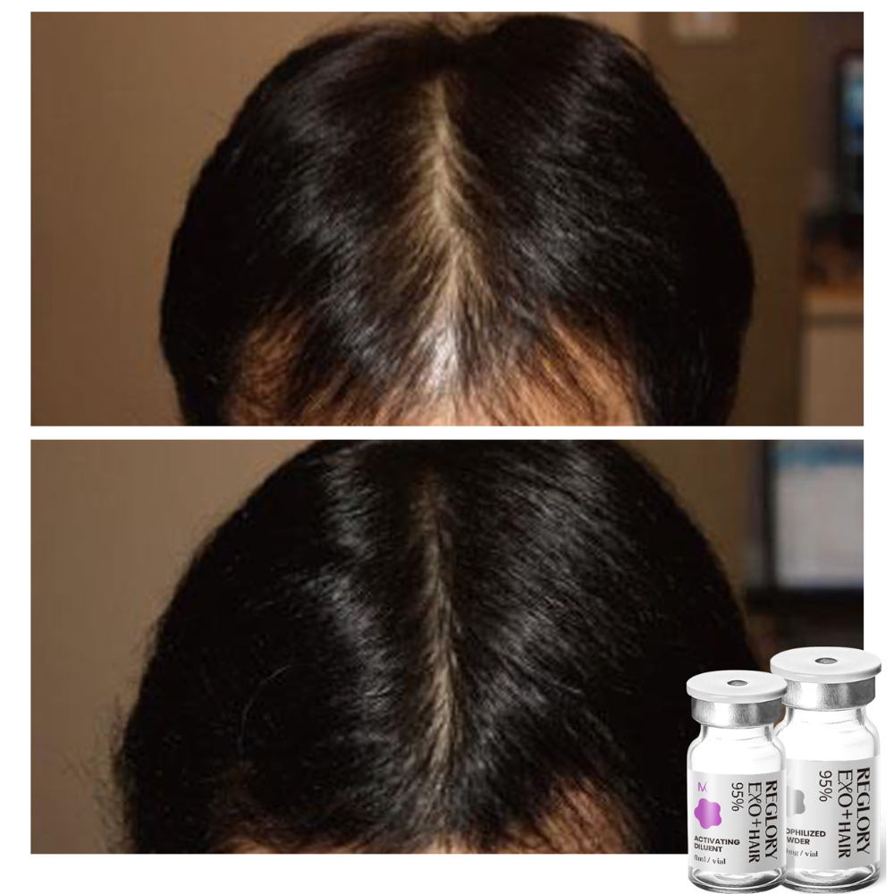 Before after treatment with Reglory EXO⁺ Hair Growth Serum