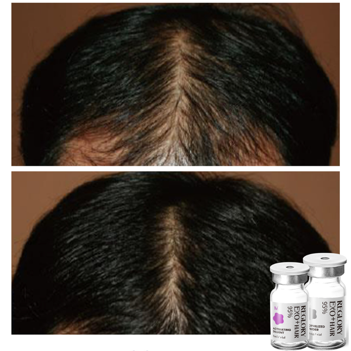 Before after Reglory EXO⁺ Hair Growth Serum hair is growing and thicker than before