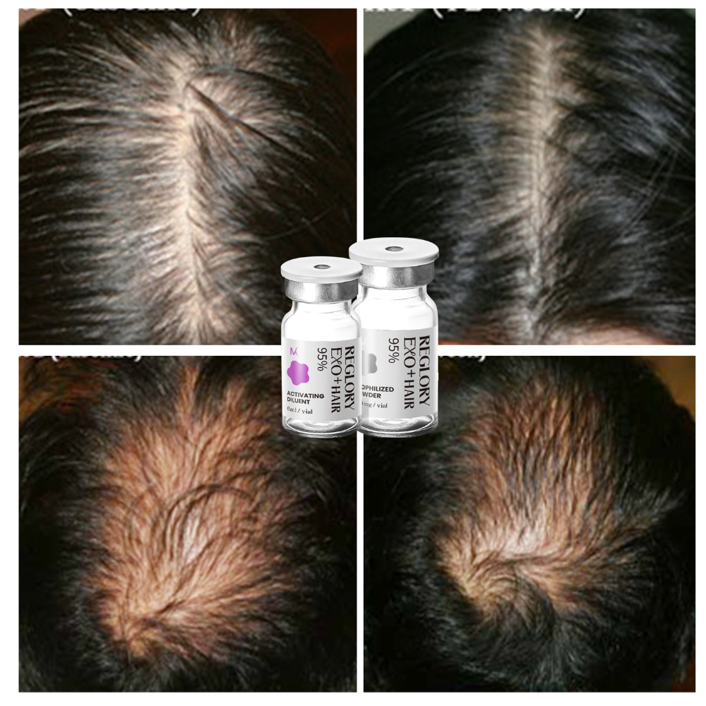 Hair is growing after treatment with Reglory Exo+ Hair Before After