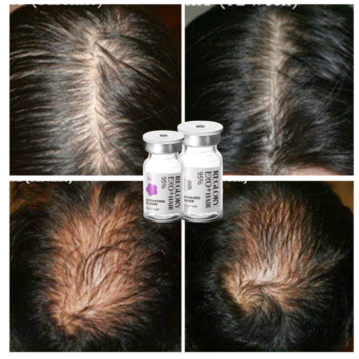 Hair is growing after treatment with Reglory Exo+ Hair Before After