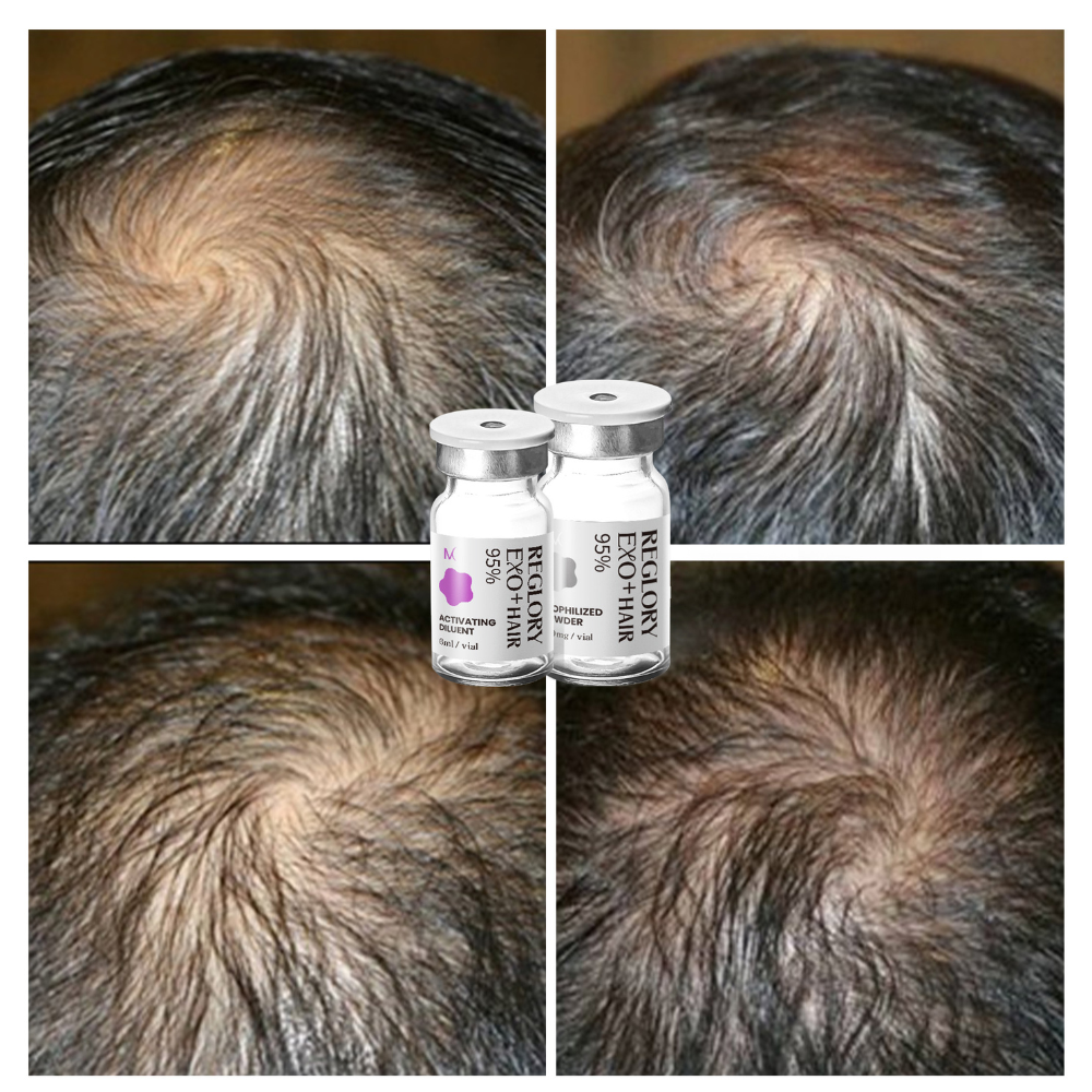 Hair is growing after treatment with Reglory Exo+ Hair Before After