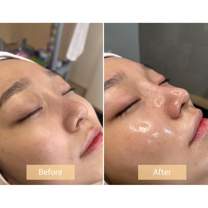 Before and after facial treatment comparison with Stayve Ampoule