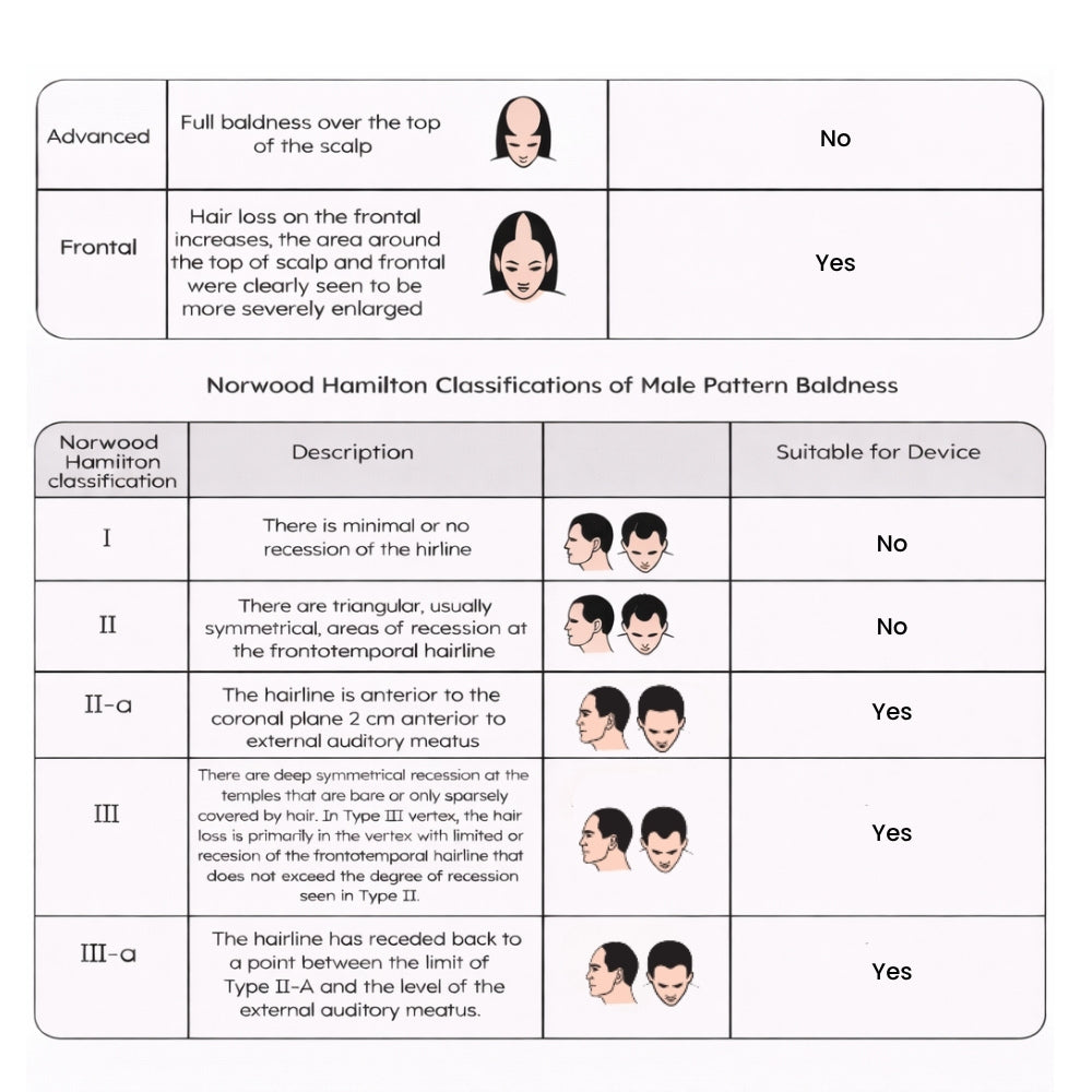 2 tables in this image, one with Ludwig classifications for female pattern baldness, Second table detailing the Norwood Hamilton Classification of Male Pattern Baldness with illustrations 