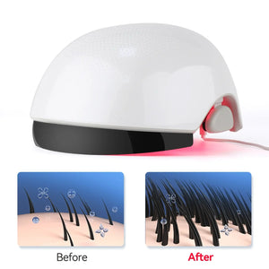 VolumeMax Hair Growth Helmet 162 Laser Diodes - FDA Cleared