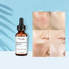 Load image into Gallery viewer, salicylic acid 2% serum with before and after usage